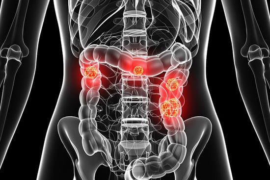 रेक्टममा गाठो